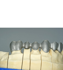 3D打印钴铬牙齿案例