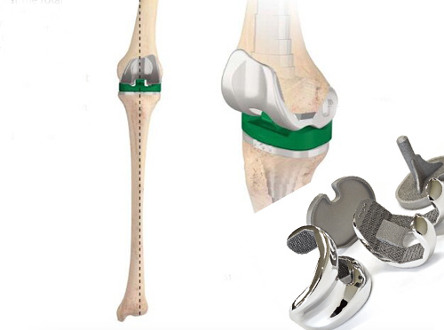 3D打印膝关节骨